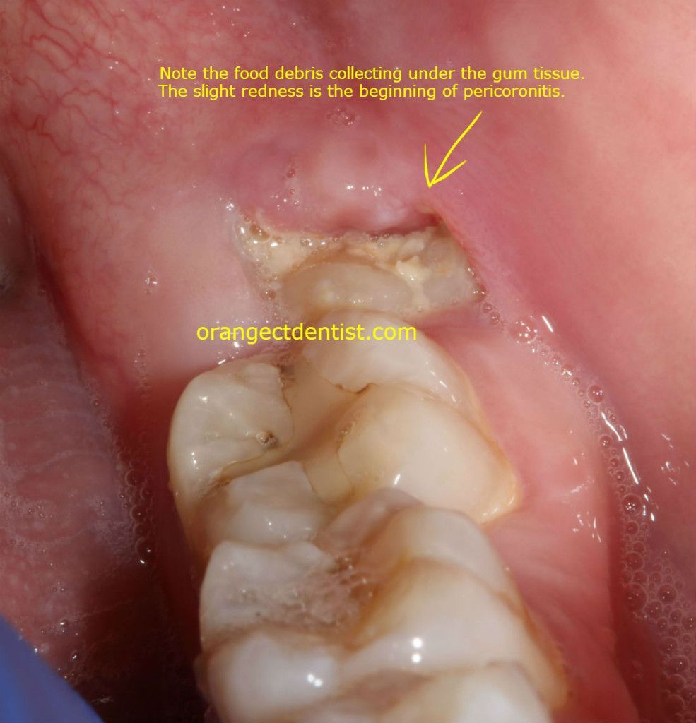 How Long Does It Take To Heal From Wisdom Teeth Surgery