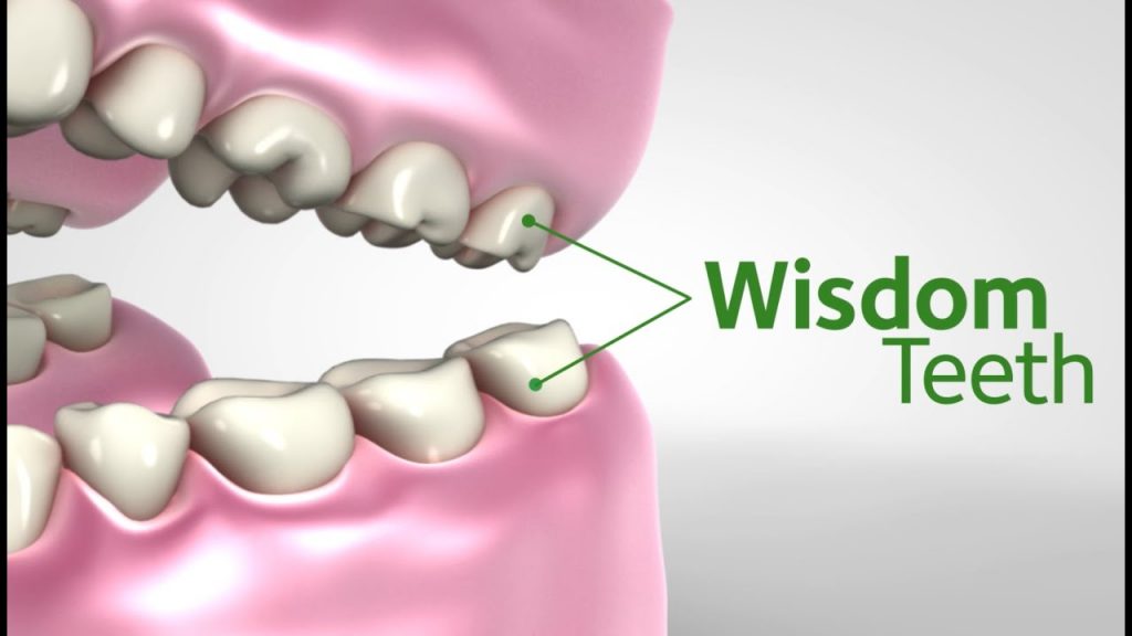 wisdom teeth signs
