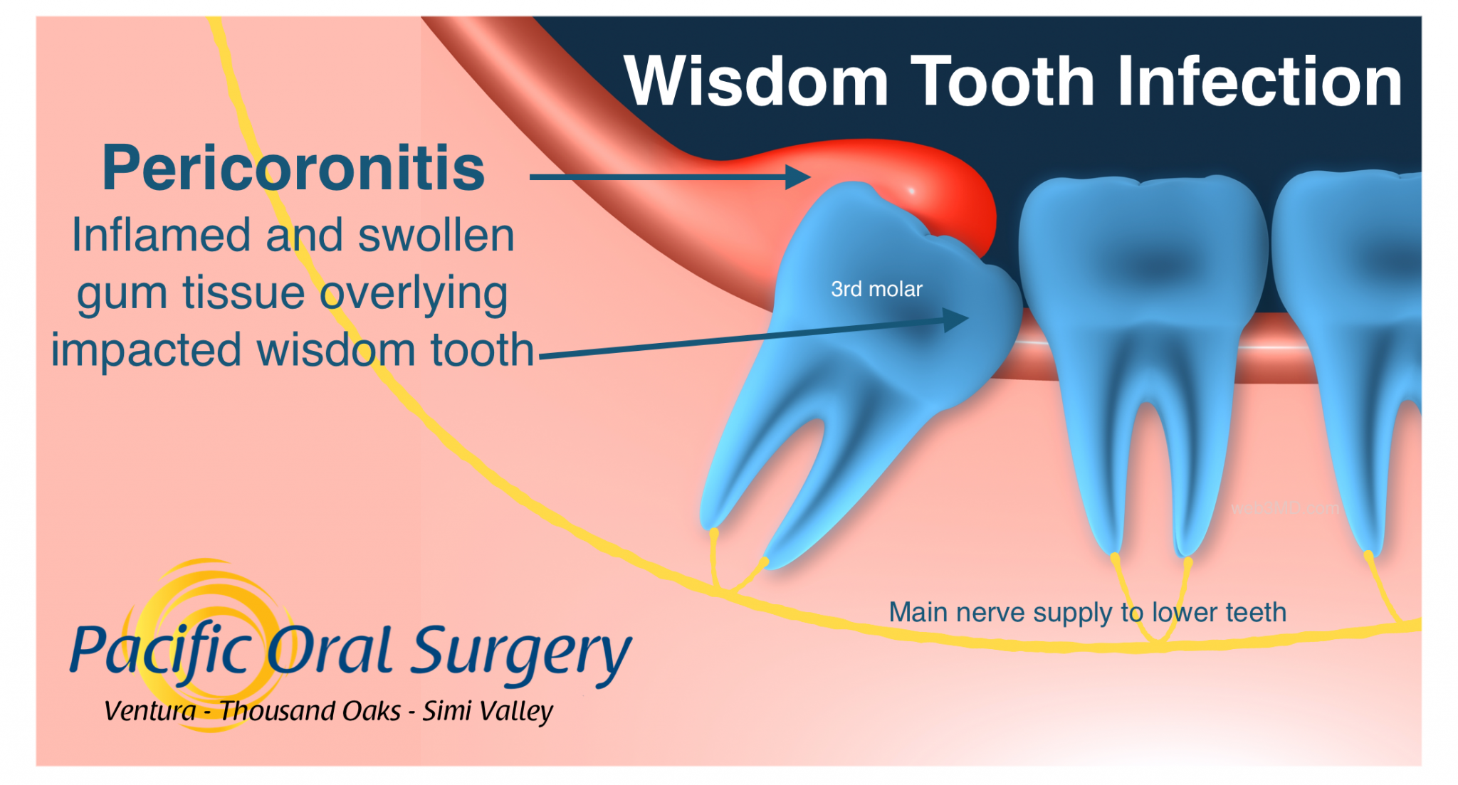 Can Wisdom Teeth Cause Ear Pain Boston Dentist Congress Dental Group Federal St Floor