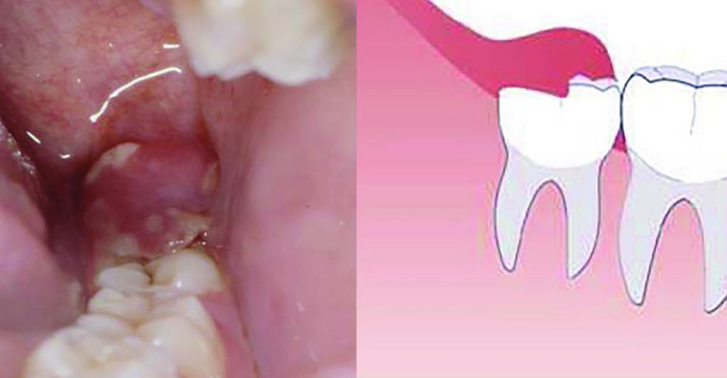 Wisdom Teeth Coming In Symptoms – Boston Dentist