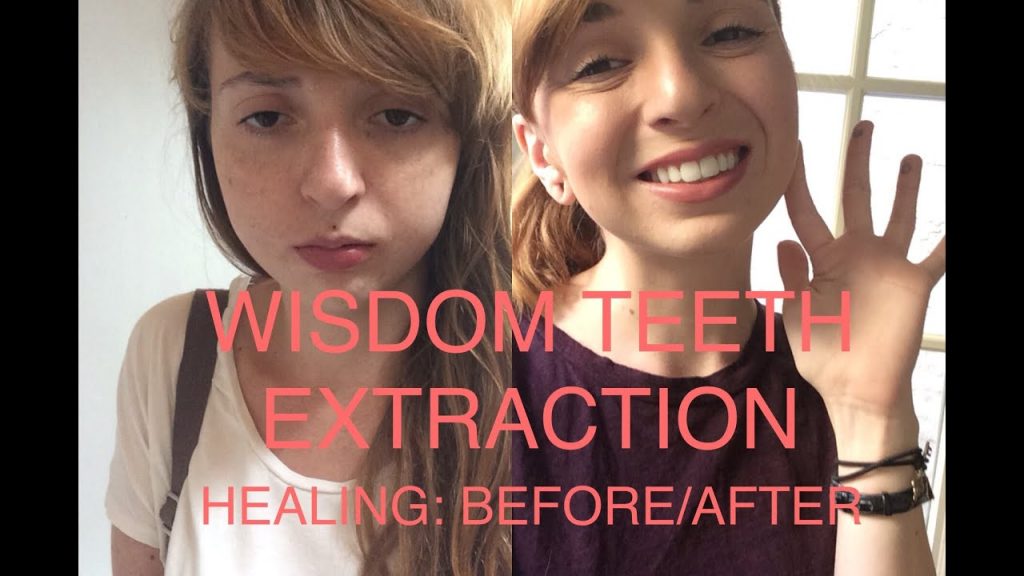 wisdom tooth extraction swelling