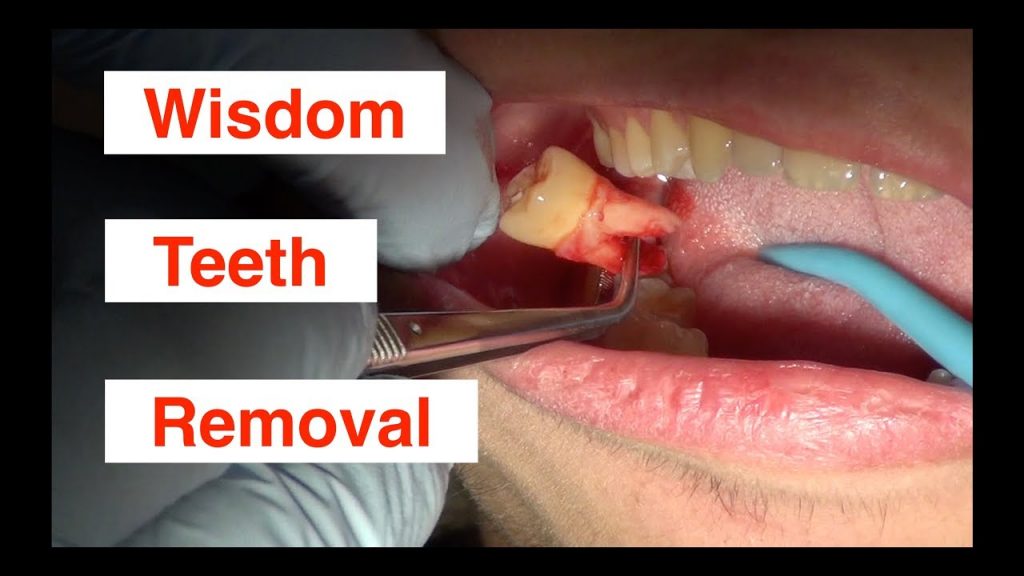 is getting wisdom teeth removed painful?