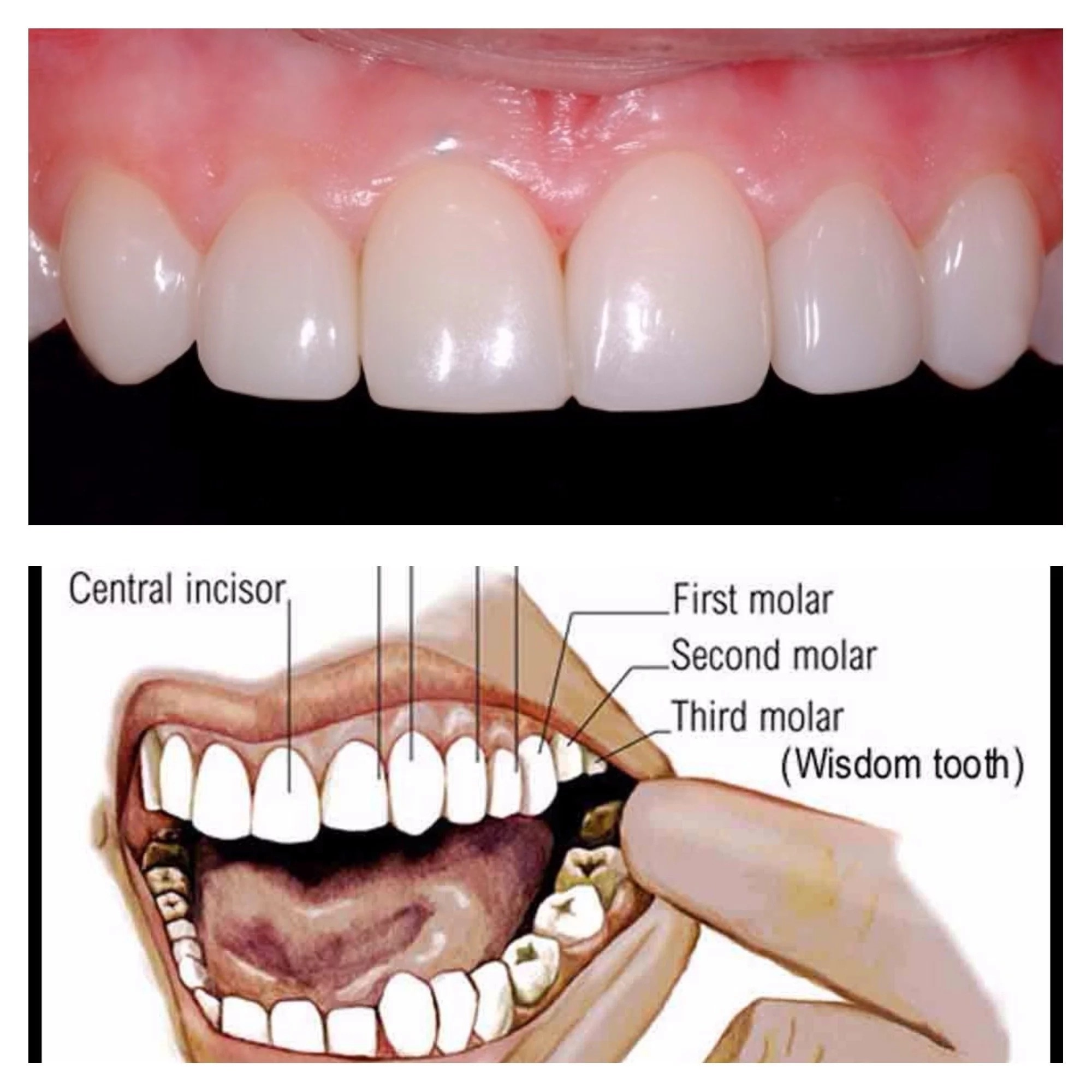 Wisdom Tooth Function Vestigial 