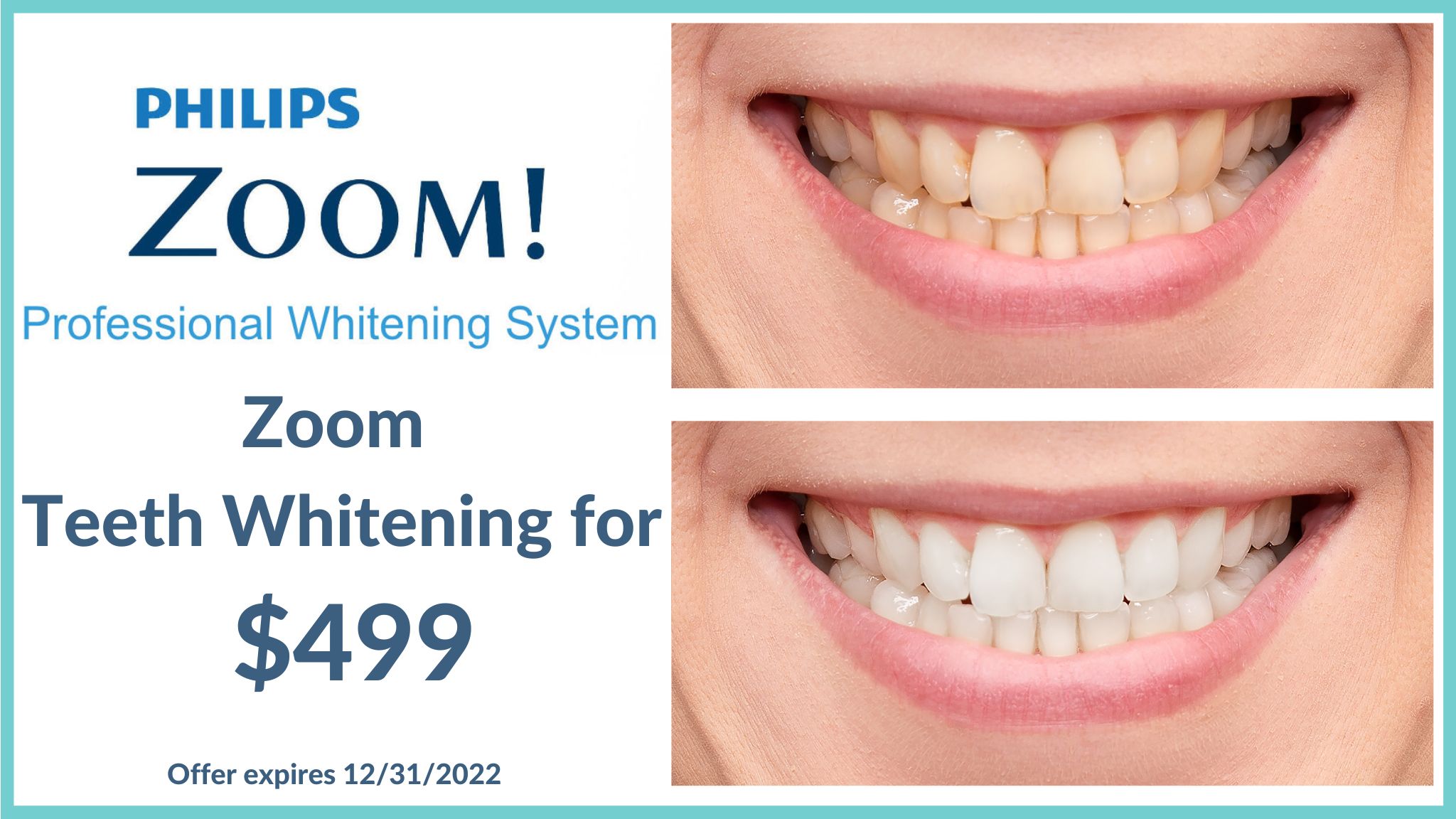 zoom teeth whitening Boston before and after