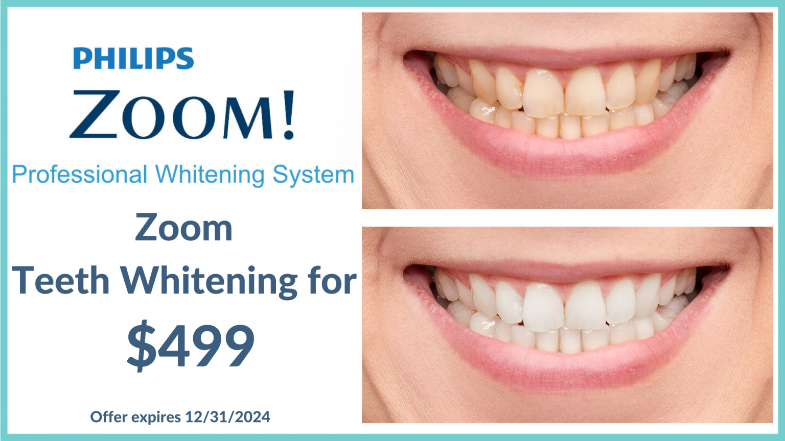 Zoom Teeth Whitening Boston Dentist Congress Dental Group 160